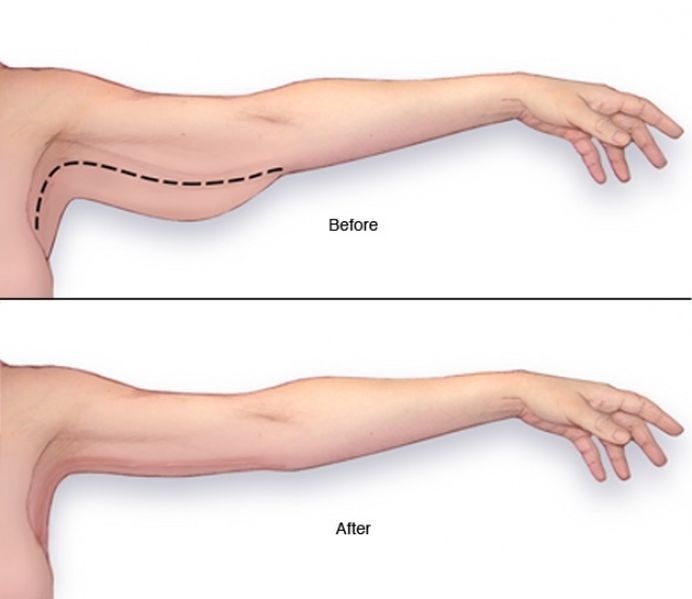 Cum să pierdeți rapid grăsimea pentru brațe pentru femei